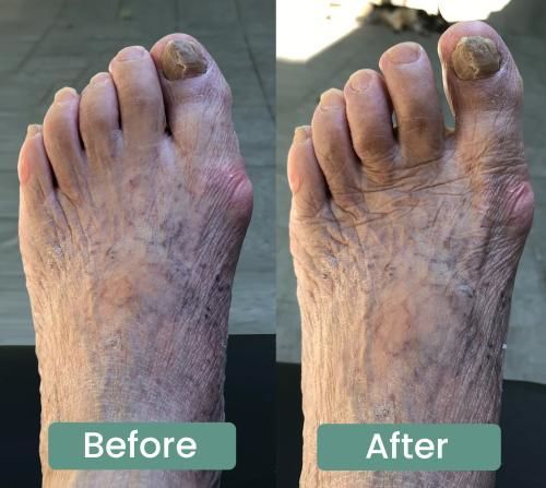 Customer bunion comfort support review image