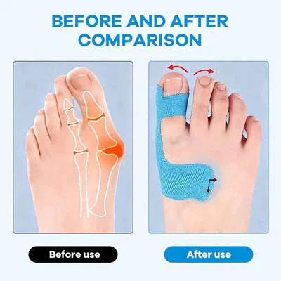 Before and after bunion correction muscle tape comparison