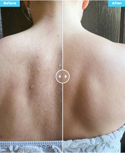 Before and after back skin texture with regular silicone scrubber routine
